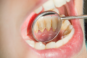 歯が黄ばんでしまう原因って？